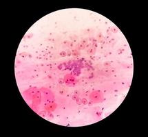 Paps smear under microscopy showing inflammatory smear with hpv related changes. Cervical cancer. SCC photo