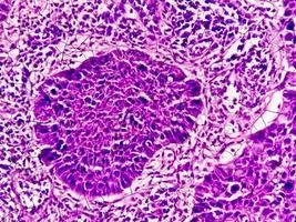 Photomicrograph showing tongue squamous cell carcinoma Grade II. Oral Invasive SCC. photo