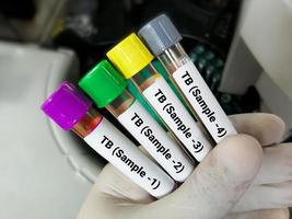 Close view of scientist hand hold blood samples for TB Gold or Quantiferon test. 4 samples for TB test. diagnosis for mycobacterium tuberculosis infection. photo