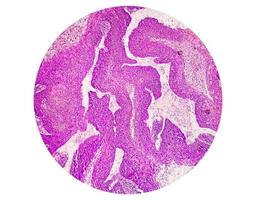 Photomicrograph showing tongue squamous cell carcinoma Grade II. Oral Invasive SCC. photo