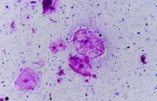 Gram stain of High vaginal swab, photomicrograph. photo