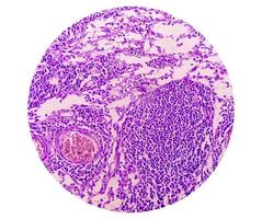 fotomicrografía de adenocarcinoma de estómago. adenocarcinoma gástrico. foto