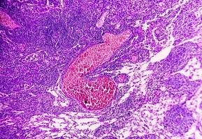 Photomicrograph of Stomach Adenocarcinoma. Gastric Adenocarcinoma. photo