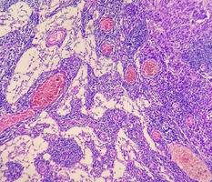 Photomicrograph of Stomach Adenocarcinoma. Gastric Adenocarcinoma. photo