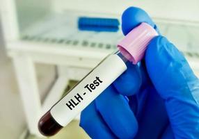 Blood sample for HLH or Hemophagocytic Lymphohistiocytosis, a rare fatal condition in which white blood cells damage organs, including bone marrow, liver, spleen. photo