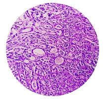 fotomicrografía de adenocarcinoma de estómago. adenocarcinoma gástrico. foto