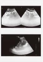 full abdomen ultrasound sonogram photo