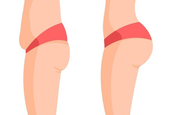 Thigh fat. Before and after weight loss woman body shape