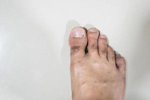 las uñas encarnadas son uñas inflamadas con pus en el suelo. problemas de uñas de los pies sobre fondo gris foto