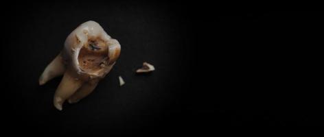 Macro shot of a decayed teeth till root after extraction of dentist. photo