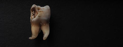 Macro shot of a decayed teeth till root after extraction of dentist. photo