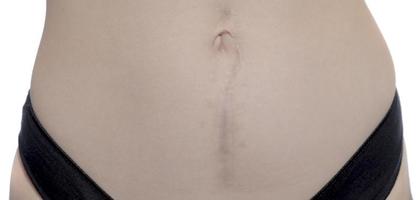 European woman with long abdominal scars after operation photo