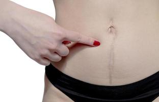 European woman with long abdominal scars after operation photo