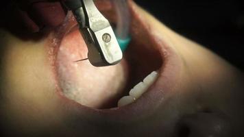 Nahaufnahme eines attraktiven Mädchens behandelt Zähne vom Zahnarzt video