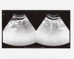 full abdomen ultrasound sonogram photo