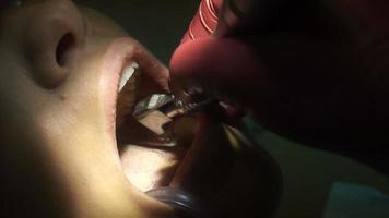 El primer plano de una mujer bonita trata los dientes del dentista video