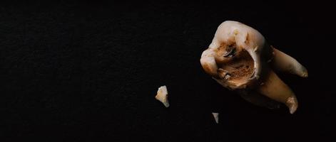 toma macro de dientes cariados hasta la raíz después de la extracción del dentista. foto