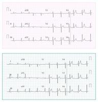 Heart Cardiogram Chart Vector. Set Healthy Heart Rhythm, Ischemia, Infarction. Vitality Heartbeat, Heart Electrocardiogram, Pulse Line vector