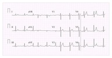 Heart Cardiogram Chart Vector. Illustration Of Wave Form On Checked Ecg Graph. Heart Rhythm, Ischemia, Infarction. Vitality Heartbeat vector