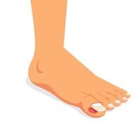 ingrown nail. onychocryptosis. nail disease, flat vector illustration