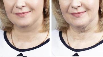 Part of the face of an elderly woman before and after cosmetic procedures.Elderly woman face wrinkles before and after procedures photo