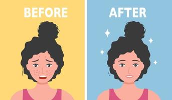 Woman face acne before and after skin care treatment in flat design. vector