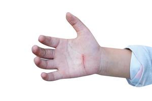 mano de niño con herida sobre fondo blanco