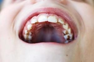 open mouth of a child boy with plaque or calculus on the teeth close. oral hygiene concept photo