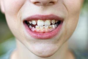 boca abierta de un niño con placa o cálculo en los dientes cerrados. concepto de higiene bucal foto