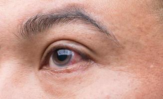 Eye irritation concept  Red eye of man,  conjunctivitis eye or after getting dust photo