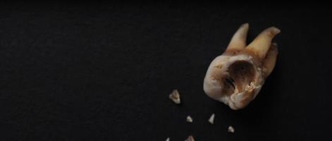 Macro shot of a decayed teeth till root after extraction of dentist. photo