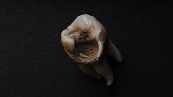 Macro shot of a decayed teeth till root after extraction of dentist. photo