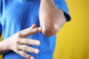 men applying petroleum jelly on elbow photo