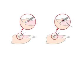 Nails cuticle instruction guide. Cutter manicure instrument. Tutorial. vector