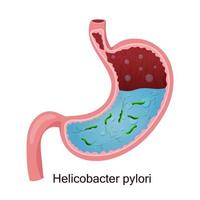 helicobacter pylori en el estómago. ilustración vectorial, estilo de dibujos animados, fondo blanco vector