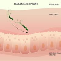 Helicobacter pylori infection process in human stomach vector