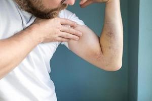 Man examines a large bruise on his arm caused by an injury. Close-up. photo