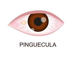 Pinguecula. Conjunctival degeneration. Eye disease. Human organ of vision with pathology vector