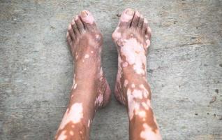 The old man leg with skin condition that causes loss of melanin posing indoors. The foot model in black tank top suffering from vitiligo disorder. photo