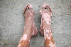 The old man leg with skin condition that causes loss of melanin posing indoors. The foot model in black tank top suffering from vitiligo disorder. photo