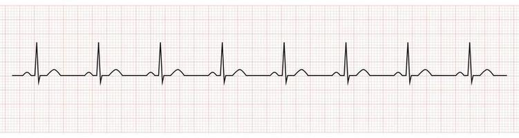 electrocardiograma que muestra el ritmo sinusal normal del paciente vector