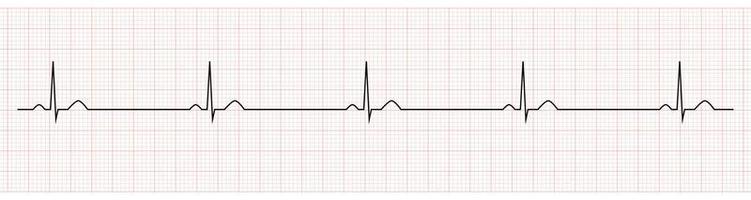 EKG Showing Sinus Bradycardia of Patient vector