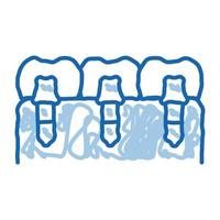 Dental Teeth Implants Biomaterial doodle icon hand drawn illustration