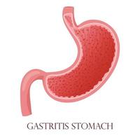 Gastritis mucosa cells inflammation illustration vector