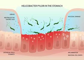 Helicobacter pylori bacteria on inflamed epithelial cells in human stomach vector