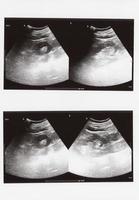 full abdomen ultrasound sonogram photo