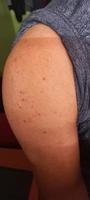 rash on arm skin photo