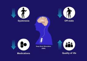 conceptos de estimulación cerebral profunda para el tratamiento de la enfermedad de parkinson. vector