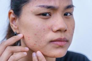 el primer plano de una joven asiática se preocupa por su cara cuando tiene problemas con la piel de la cara. problemas con el acné y la cicatriz en la piel femenina. problema de cuidado de la piel y concepto de salud. foto