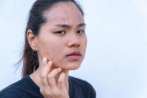 Close up of young Asian woman worry about her face when she has problems with skin on her face. Problems with acne and scar on the female skin. Problem skincare and health concept. photo